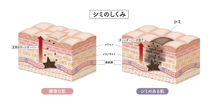シミができるメカニズムとは？