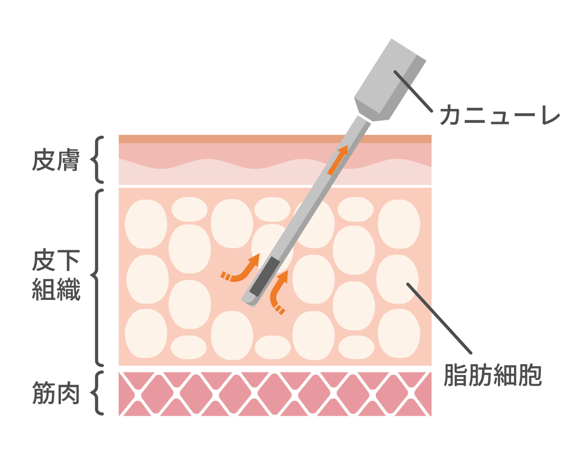 脂肪吸引　　説明　イラスト